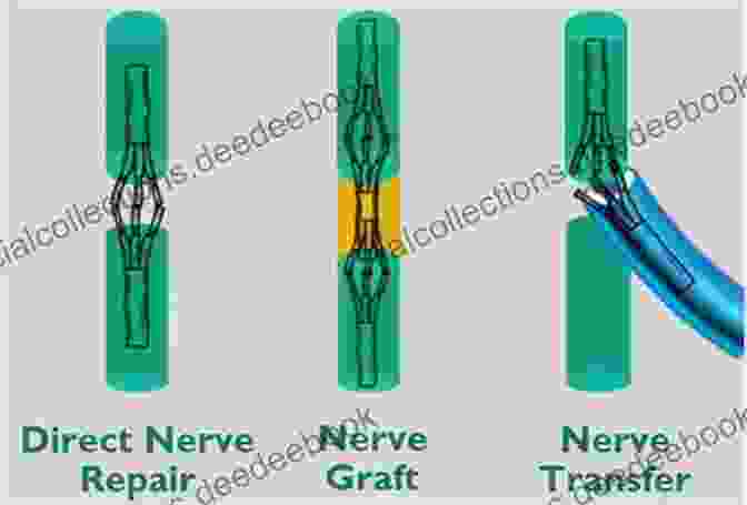 End To End Nerve Repair Technique Modern Concepts Of Peripheral Nerve Repair