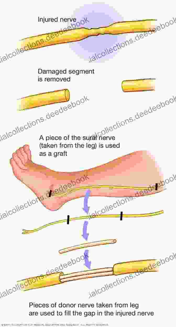 Nerve Grafting Technique Modern Concepts Of Peripheral Nerve Repair